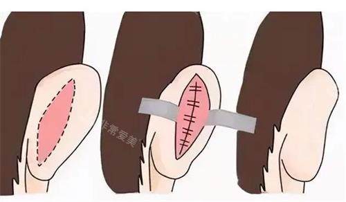 韩国招风耳矫正手术经历分享:术后整体面部都变得自然协调不少!