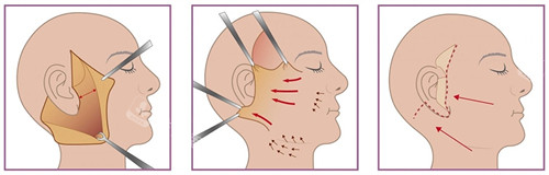 面部提升手術(shù)過程一覽