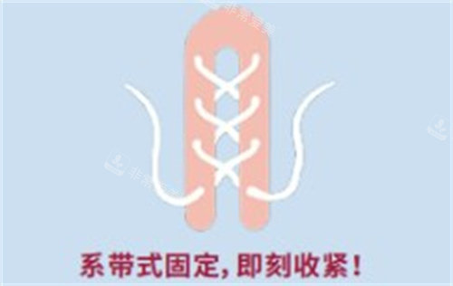 再生陰道緊縮術(shù) 再生陰道緊縮術(shù)