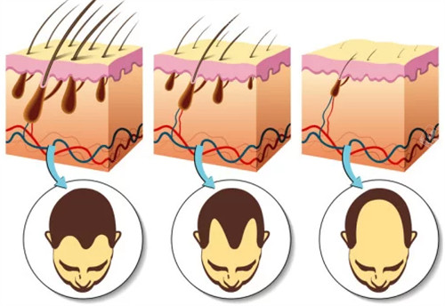 不同程度脫發(fā)的對(duì)比圖解