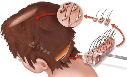 毛囊移植部位演示图