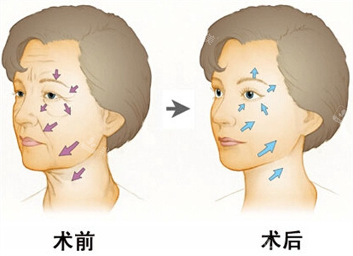 面部提升术前后对比