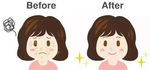 面部提升抗衰对比