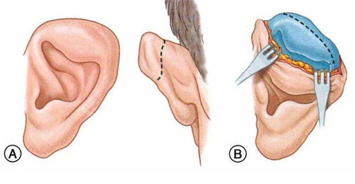 耳畸形矯正術(shù)