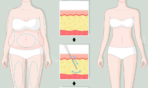 全身吸脂展示图