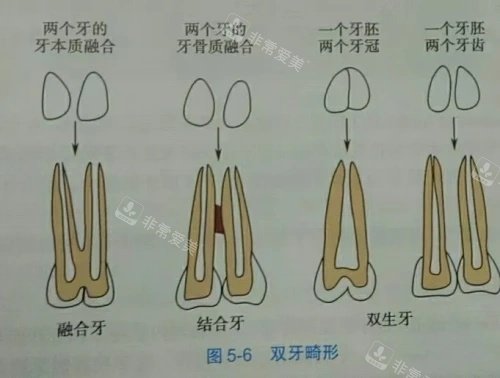 融合牙结合牙双生牙示意图