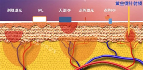 黃金微針射頻