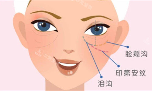 淚溝卡通圖 淚溝卡通圖