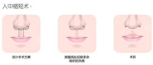 人中縮短術(shù) 人中縮短術(shù)