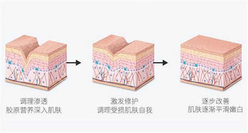 III型膠原蛋白填充原理