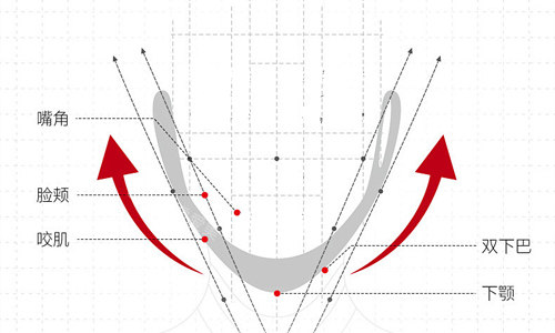 雙顎手術(shù)的線條展示