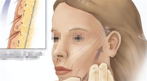 面部青春肽支架提升示意圖