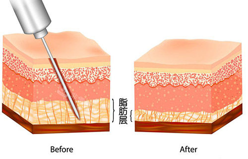 吸脂手术层级示意图