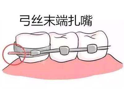 牙齒矯正弓絲末端扎嘴示意圖