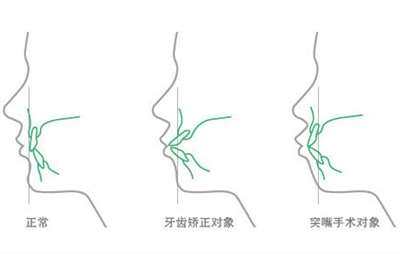 牙齒矯正適應(yīng)人群