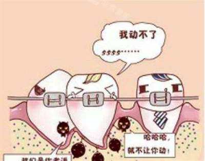 牙齒矯正卡通示意圖