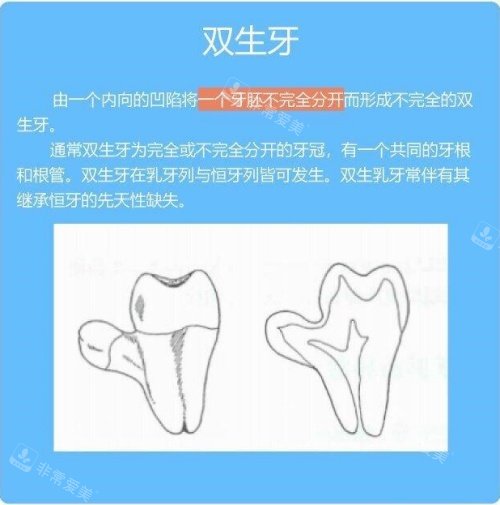 双生牙介绍示意图
