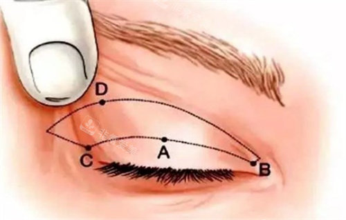 全切雙眼皮術(shù)前設(shè)計(jì)