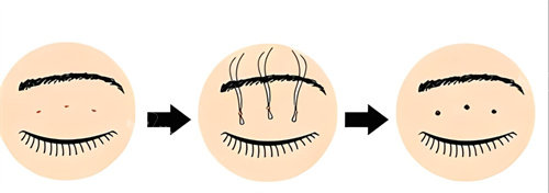 双眼皮三点术过程