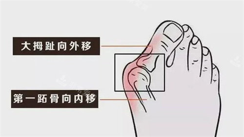 大腳骨的癥狀