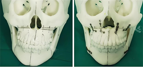正颌手术手术原理展示图