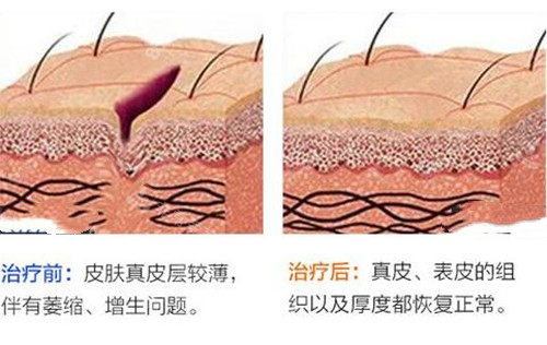 激光祛疤前后对比示意图