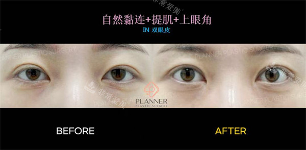 韓國Planner醫(yī)院眼修復前后對比圖