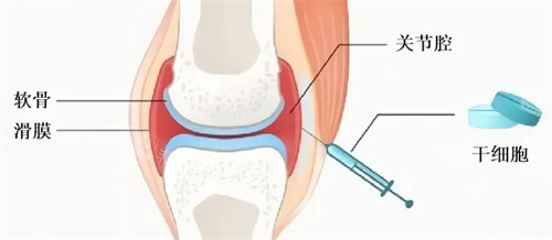 关节炎治疗过程