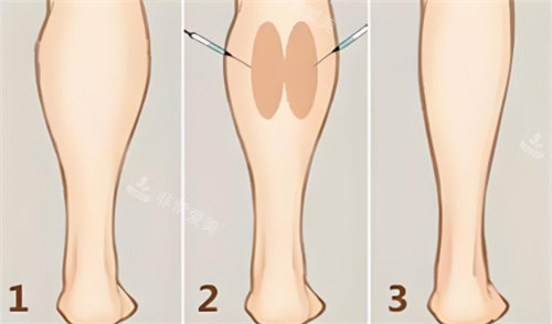注射瘦小腿对比
