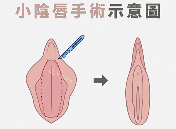 小阴唇整形前后对比