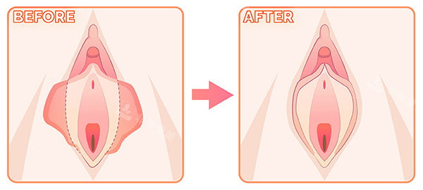 陰唇整形前后對(duì)比變化