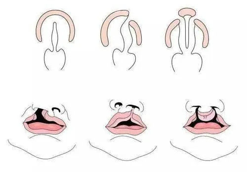 唇腭裂外形卡通示意图