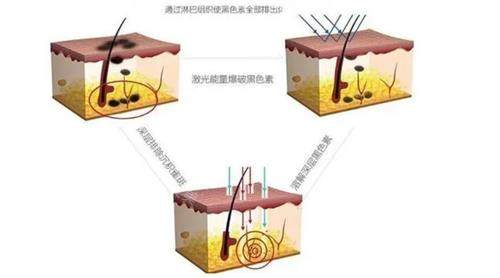 激光去痣原理