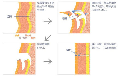 筋膜懸吊手術(shù)