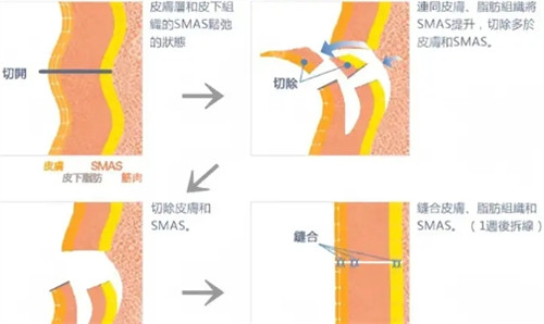 拉皮手術(shù)過程