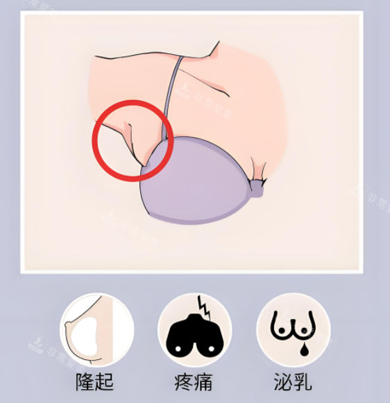 手术去副乳部位症状