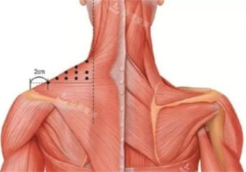 瘦肩針注射肌肉分布圖