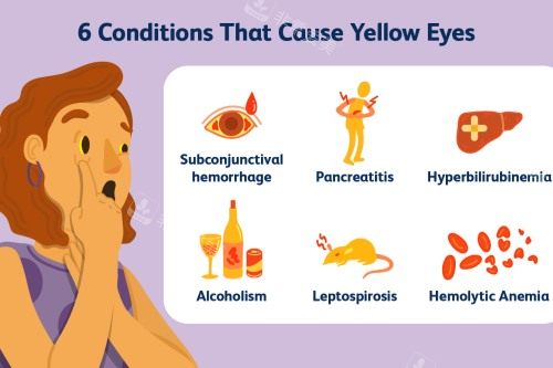造成眼睛发黄的原因