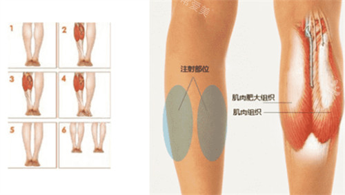 瘦腿注射點位圖