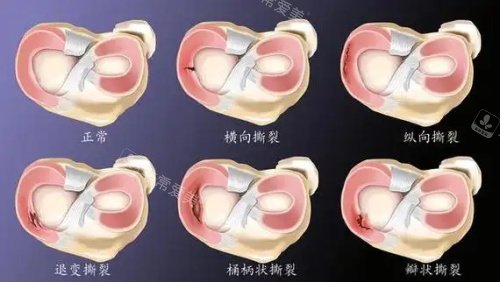 半月板損傷各種形態(tài)