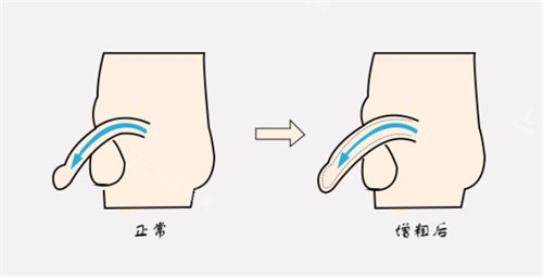 增粗術前后對比