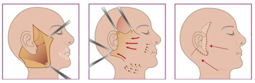拉皮手術(shù)過程