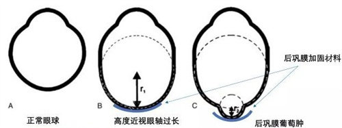后巩膜加固术