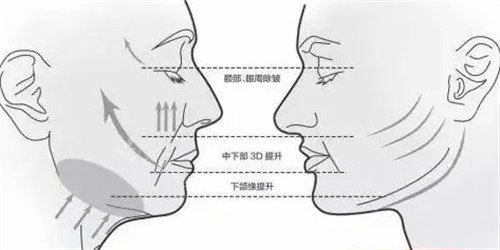 面部提升三大部位