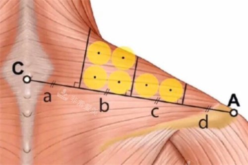 直角肩注射點(diǎn)位細(xì)節(jié)剖析