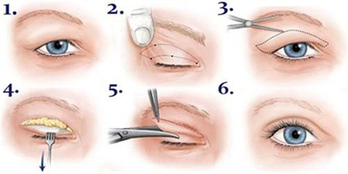雙眼皮全切術(shù)過(guò)程圖
