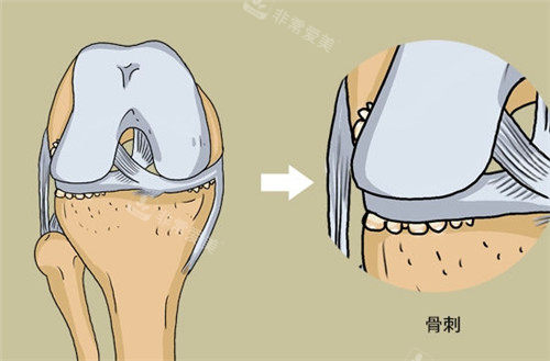 骨刺動畫圖