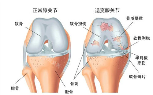 膝骨關(guān)節(jié)炎