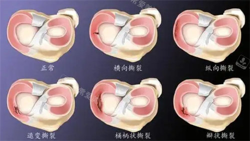 半月板損傷圖片