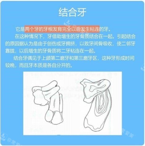结合牙介绍示意图